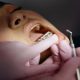 ما هي أهم وأبرز سلبيات جسر الأسنان ومشاكله المتوقعة؟