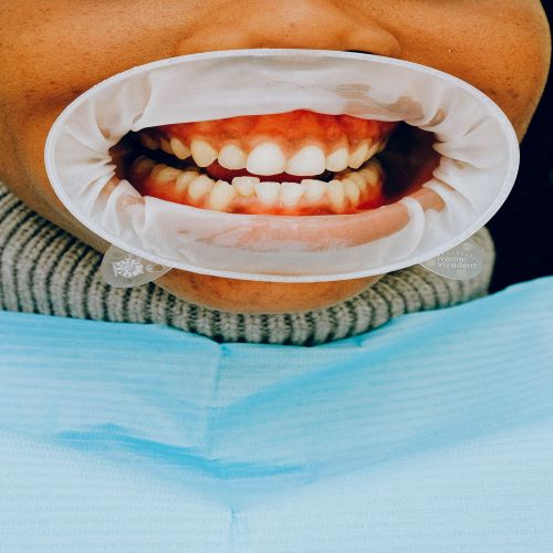 تعلم معنا كيفية منع تراكم بكتيريا البلاك على الأسنان
