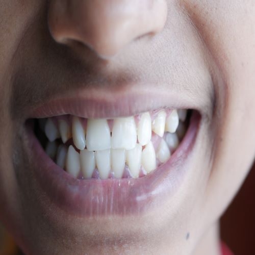 تعرف معنا على أهم وأبرز أسباب وعوامل خطر تسوس الأسنان